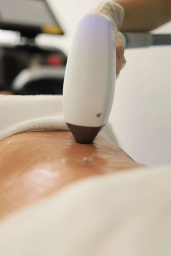 Handpiece treating the skin of the body