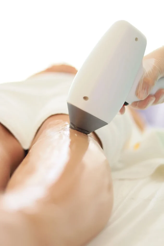 Laser hair removal handpiece on the leg