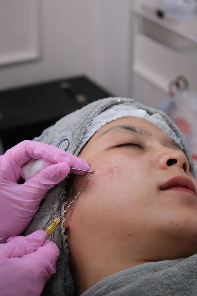 Microneedling close-up on the cheek